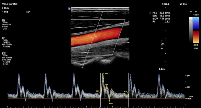 MaxVue vasculaire EPIQ L18-5