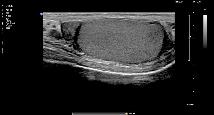 MaxVue L12-5 testicule