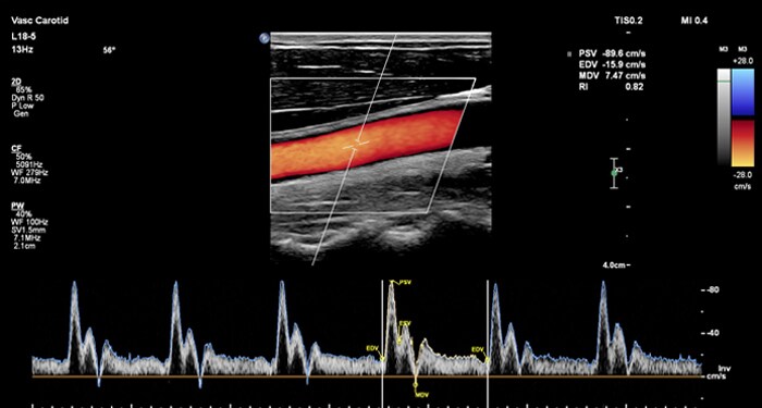 MaxVue L18-5 examen carotide