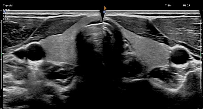 MaxVue L18-5 double thyroïde