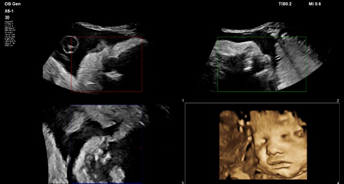 MaxVue X6-1 MPR obstétrique 3D