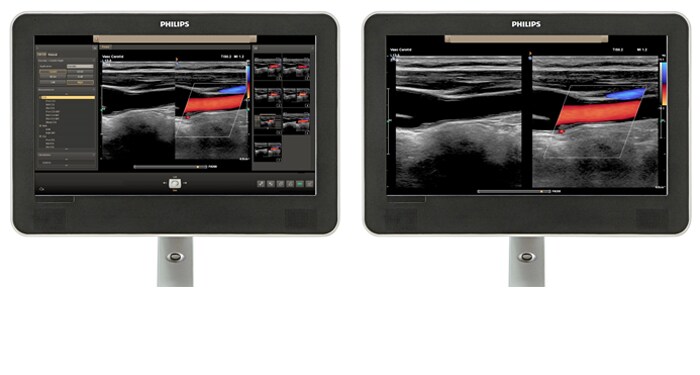 Comparaison de la zone de visualisation avec une image échographique vasculaire sur écran