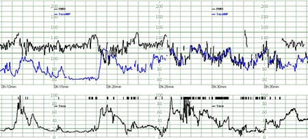 Technologie Smart Pulse de Philips