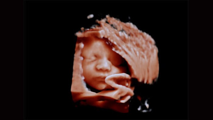 Visage du fœtus avec l’échographe Philips Affiniti et aReveal non appliqué