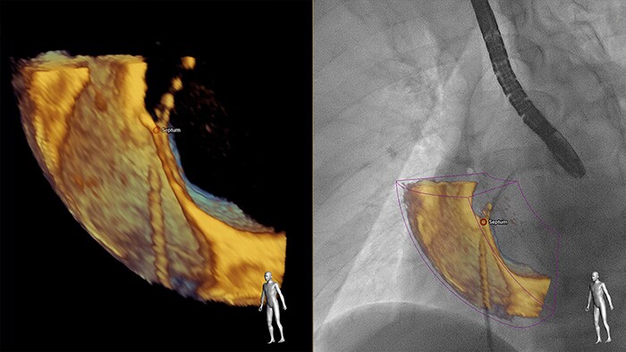 EchoNavigator fusionne automatiquement l'ETO 3D et la radiographie en temps réel