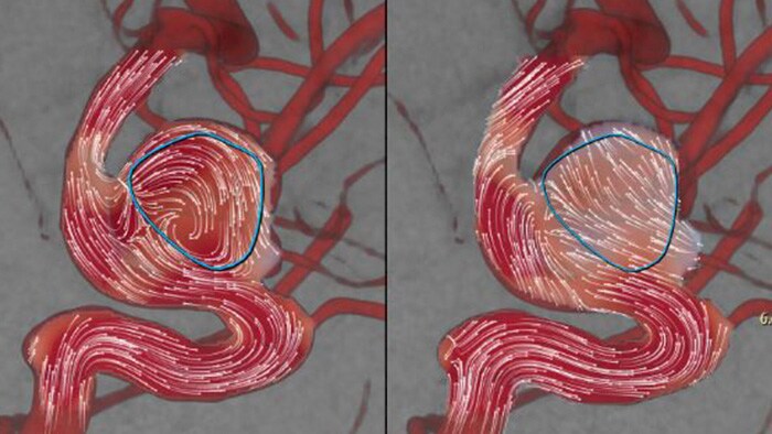 Déploiement d’un déviateur de flux sanguin AneurysmFlow