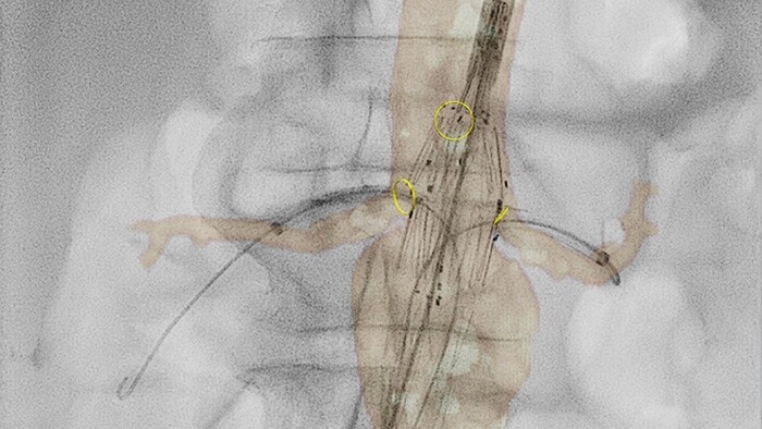 2d perfusion vascular thumb