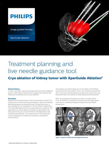 Rapport de cas clinique XperGuide Ablation