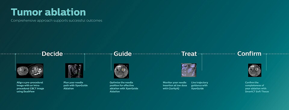 Infographie sur l’ablation tumorale