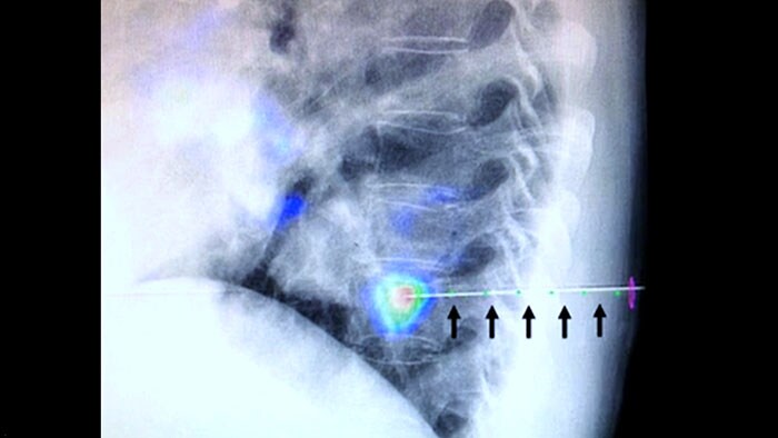 Interventions à l’aiguille très précises et sûres avec XperGuide et CBCT