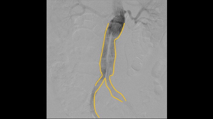 Outil de contour pour le marquage des bifurcations ou des branches latérales