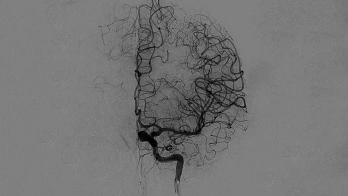 Visualisation d’angiographie par soustraction numérique (ASN)