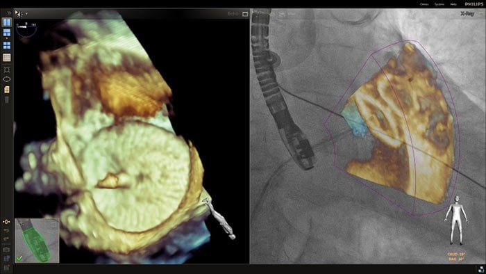 Superposition du zoom 3D dans une procédure de fermeture de l’appendice auriculaire gauche