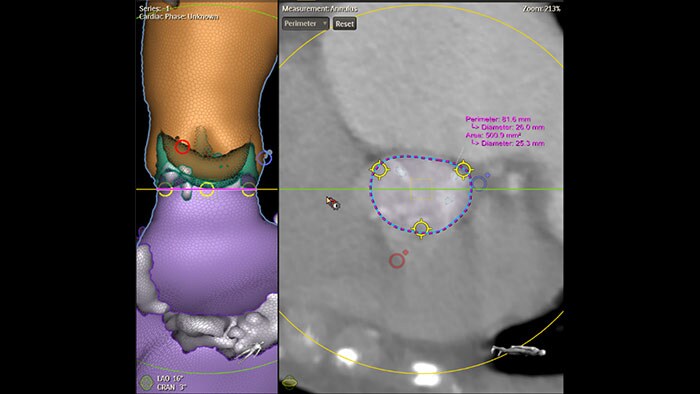 Image clinique Philips HeartNavigator