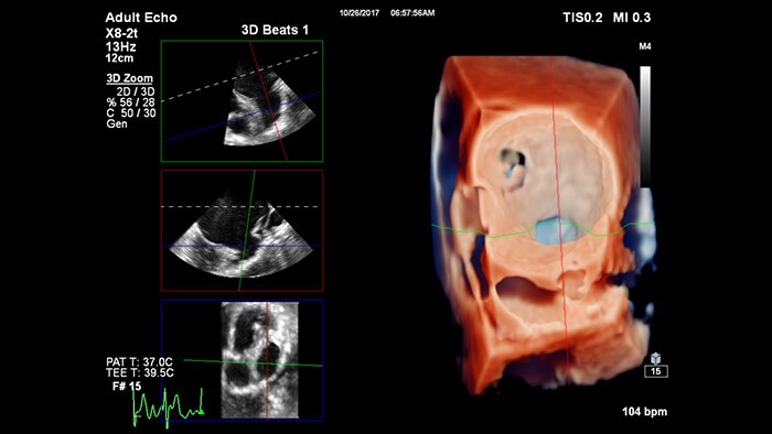 TrueVue du rendu 3D Zoom pour l’appendice auriculaire gauche avec visualisation MultiVue