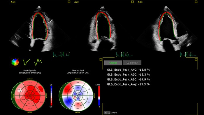 Écran d'écocardiographie