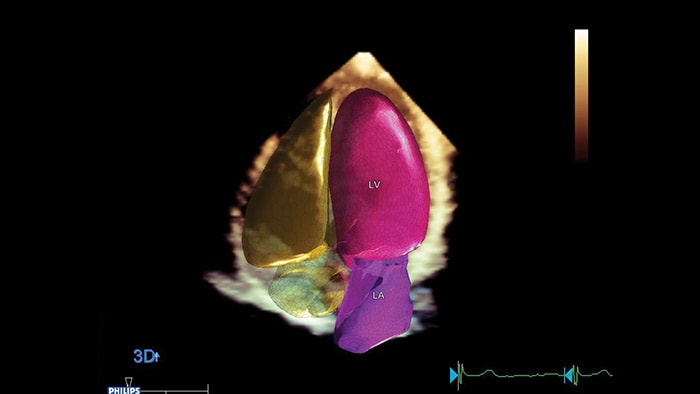 Quantification cardiologique conçue pour augmenter la confiance