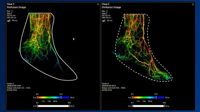 Philips SmartPerfusion