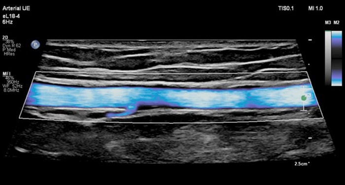 MicroFlow Imaging avec la sonde eL18-4 de Philips