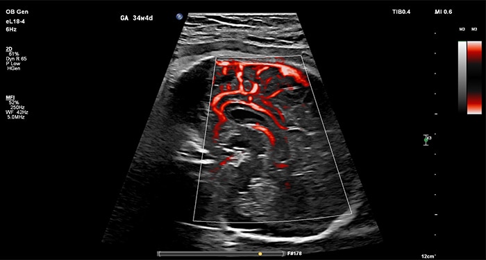 Intestin fœtal avec comparaison MicroFlow Imaging