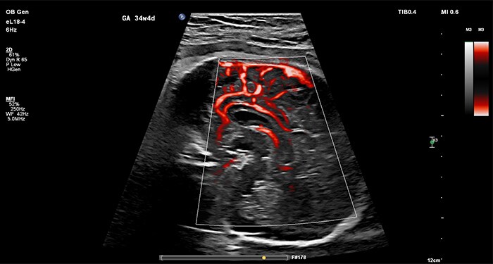 Intestin fœtal avec comparaison MicroFlow Imaging