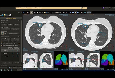 CT Lung