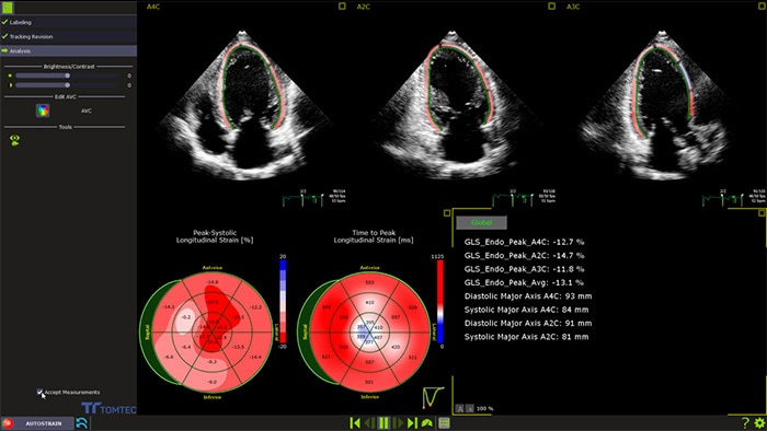 Strain sur le VG: exemple de la cardio-oncologie avec le Dr Ederhy et le Pr Cohen