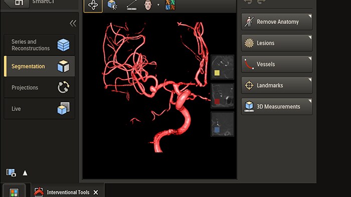 TMS Azurion Acquisition 3D à portée de main procedure interventionnelle avec Smart CT