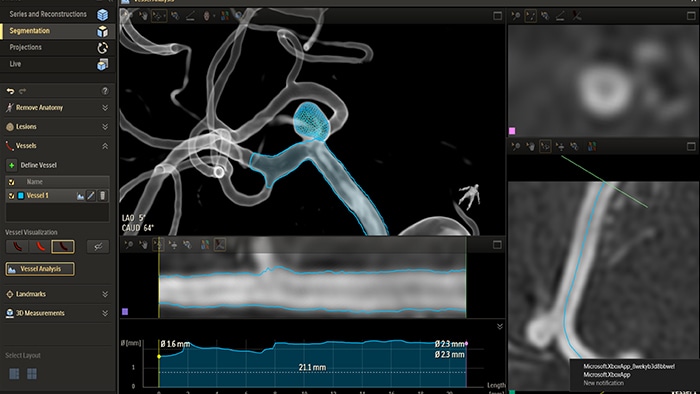 Acquisition images 3Dhaute resolution HD de type scanner pour procedures interventionnelles smartCT