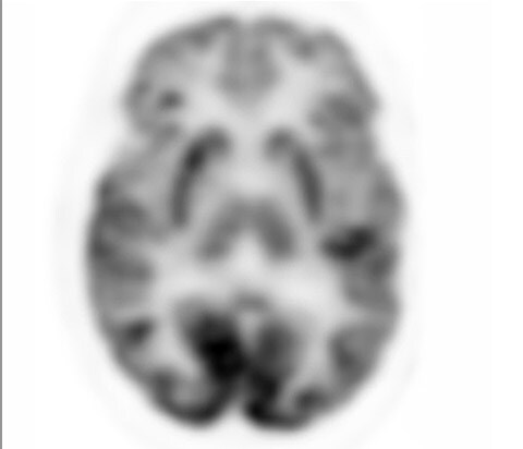 Examen d’imagerie TEP analogique du cerveau