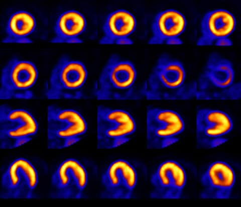 Examen d’imagerie TEP analogique du cœur