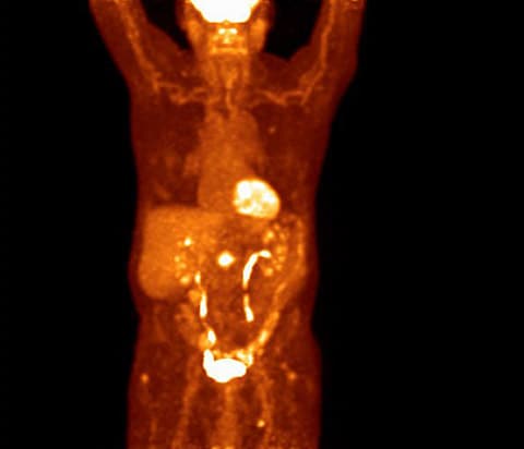 Examen d’imagerie TEP analogique du thorax