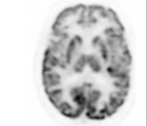 Examen d’imagerie TEP numérique Vereos du cerveau