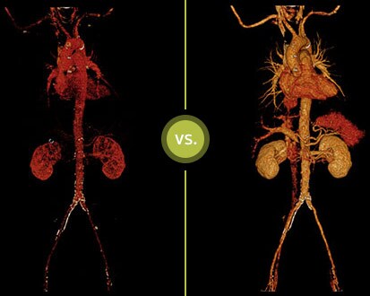 Comparaison entre une image TDM classique et une image TDM spectrale IQon