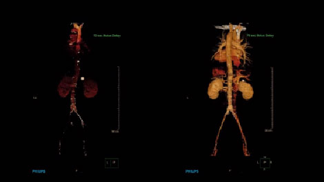 Scanner spectral IQon | Philips Healthcare