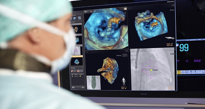 Traitement des cardiopathies structurelles via l’imagerie guidée
