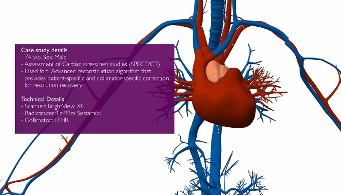 Algorithme de reconstruction avancé SPECT