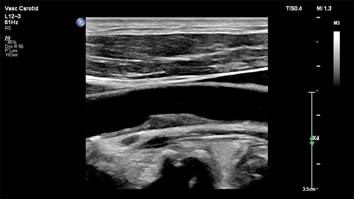 diagnostic fiable durant l’imagerie vasculaire