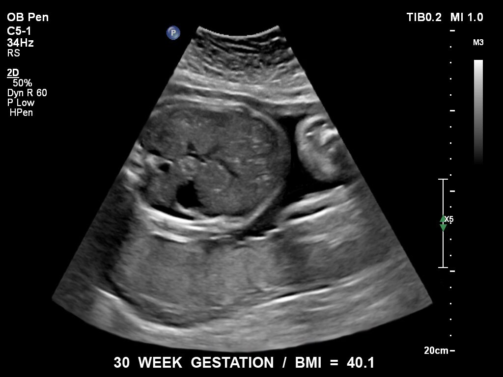 30 semaines de gestation