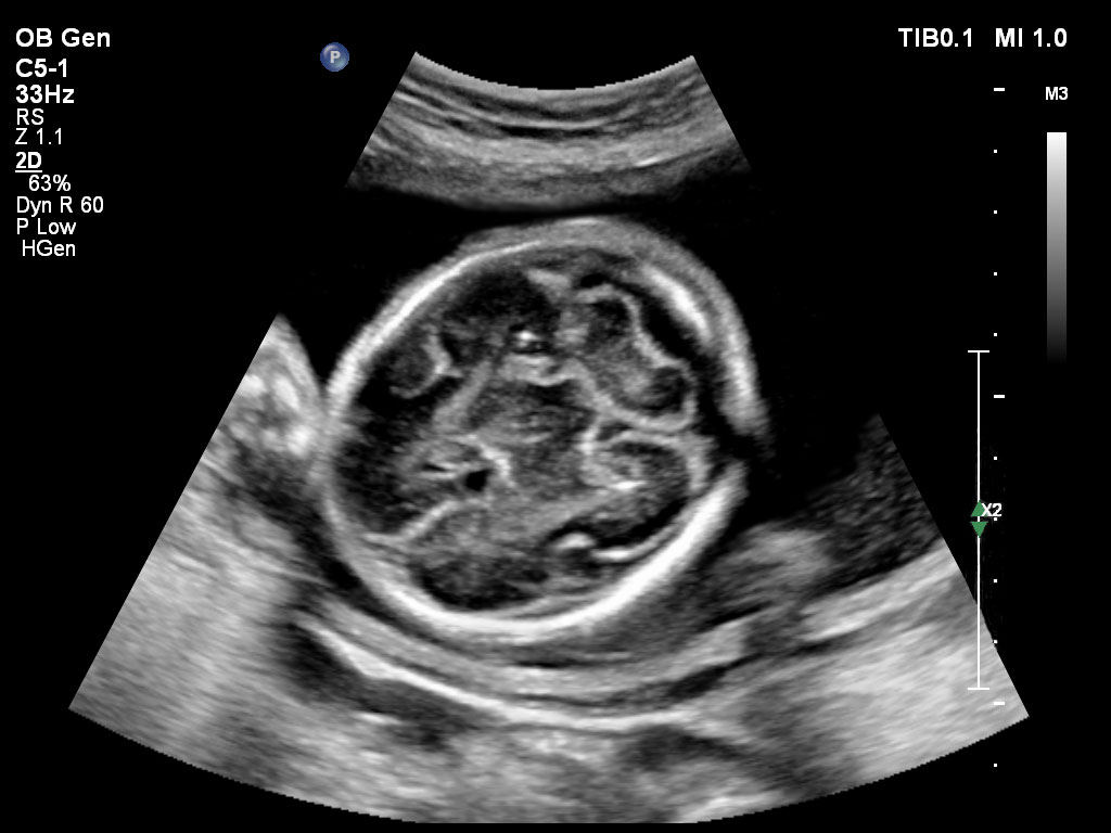 7 semaines de gestation