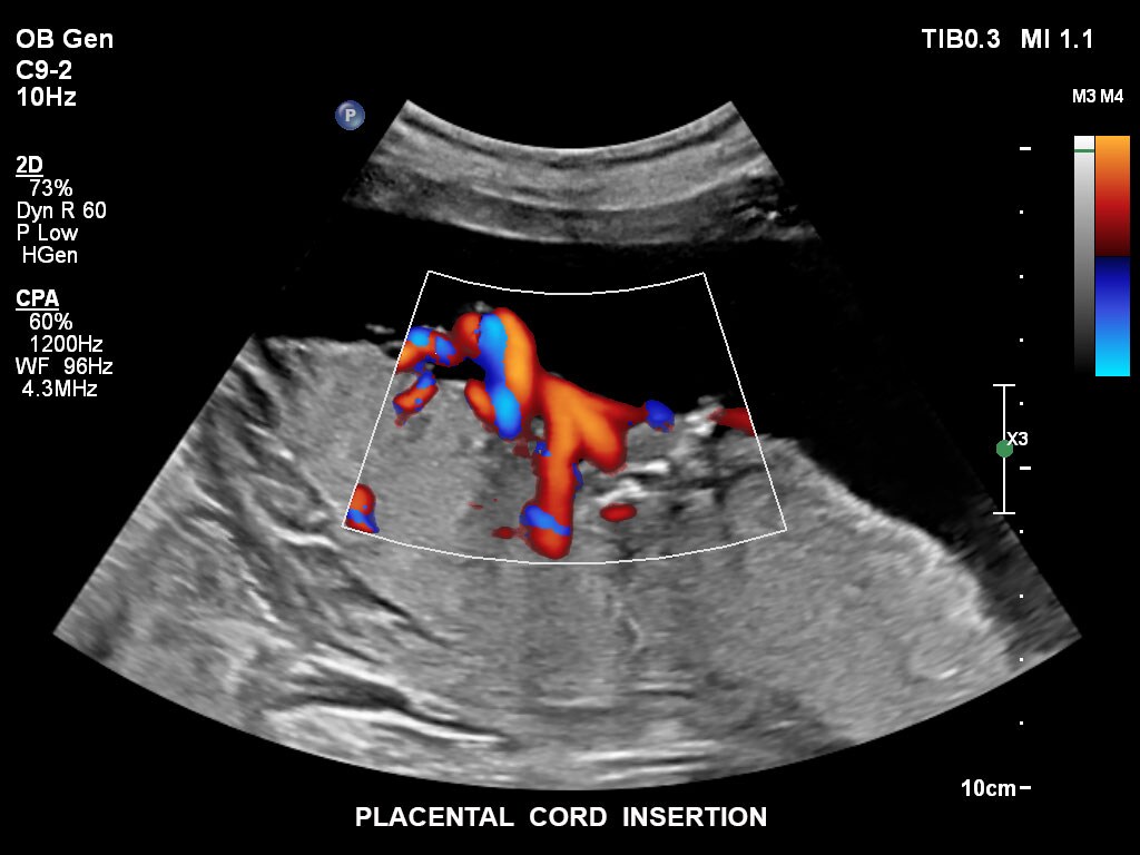 Insertion du cordon placentaire