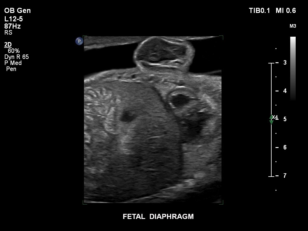 Diaphragme