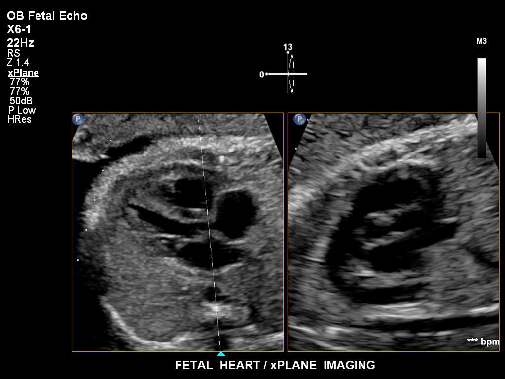 une échographie d'un bébé