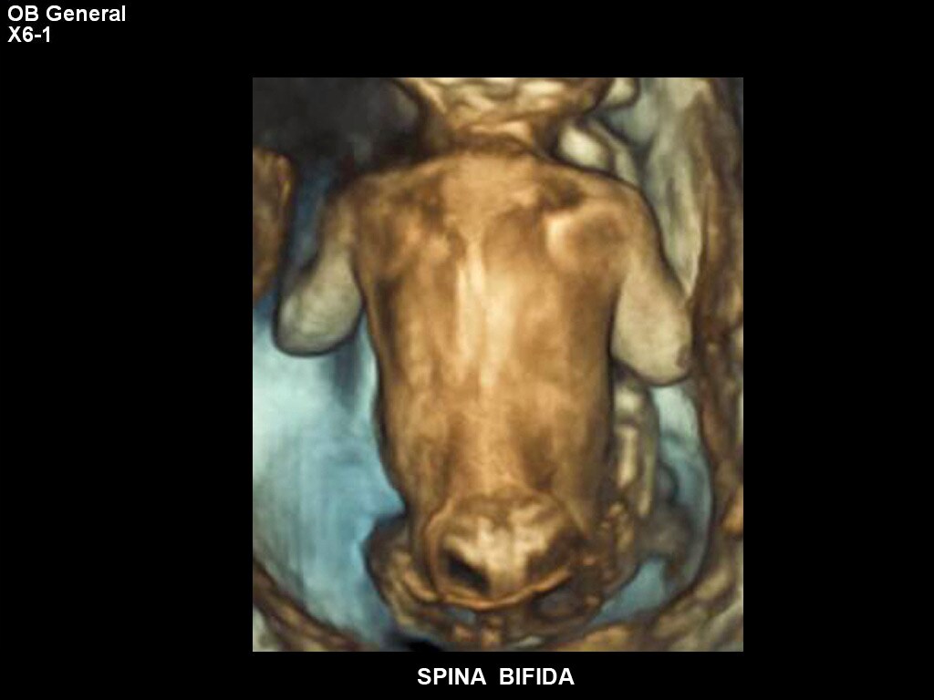 Spina bifida