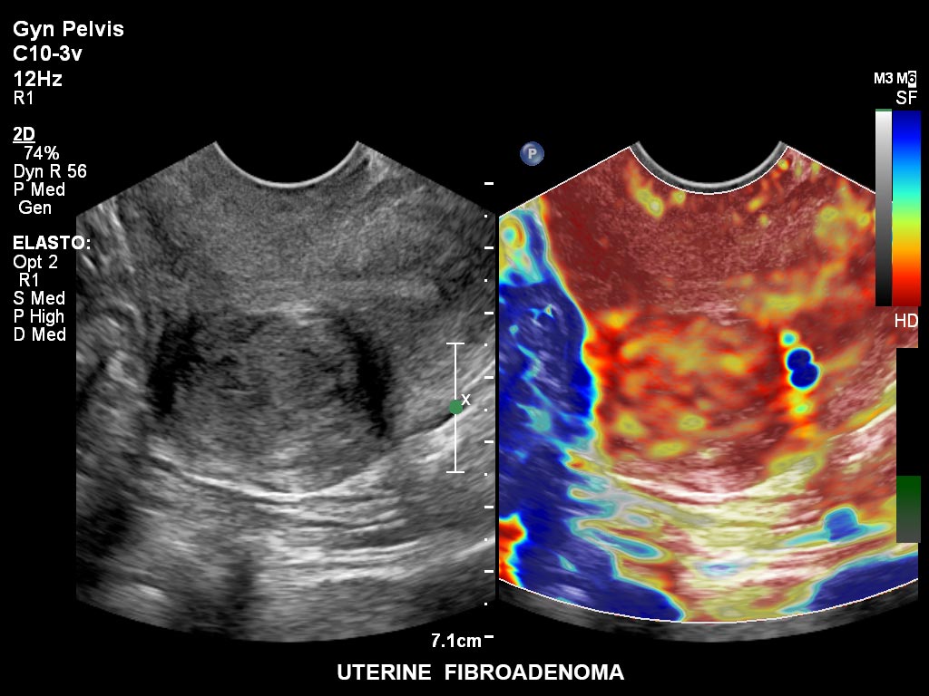 Fibroadenome utérin