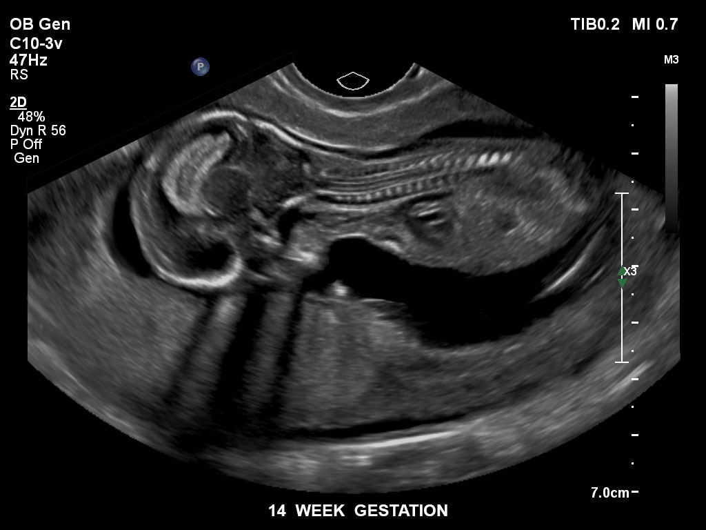 14 semaines de gestation