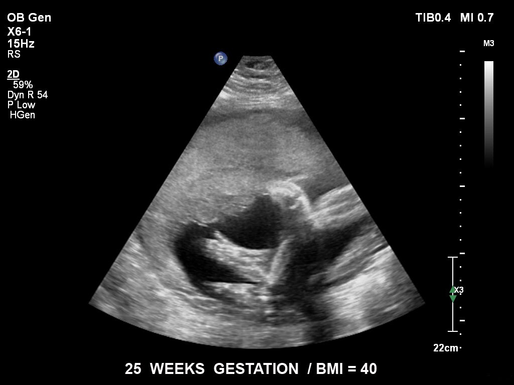  25 semaines de gestation