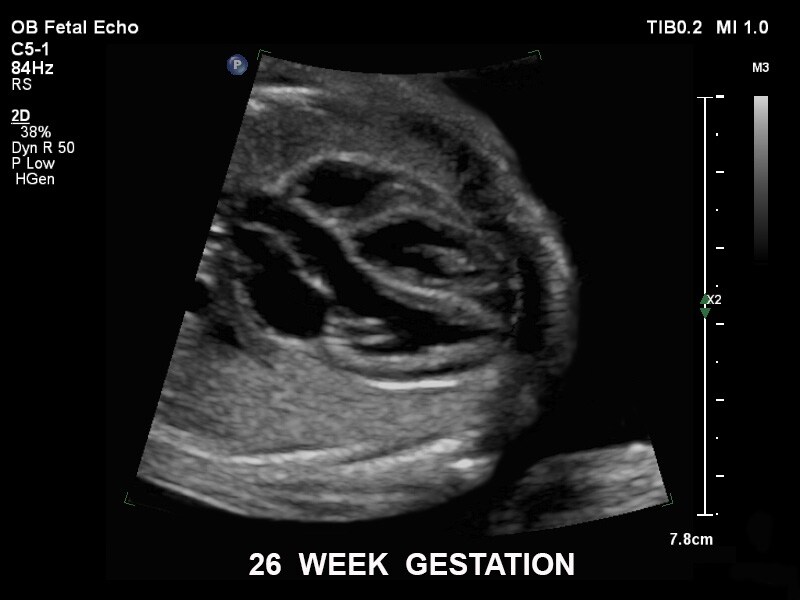 26 semaines de gestation