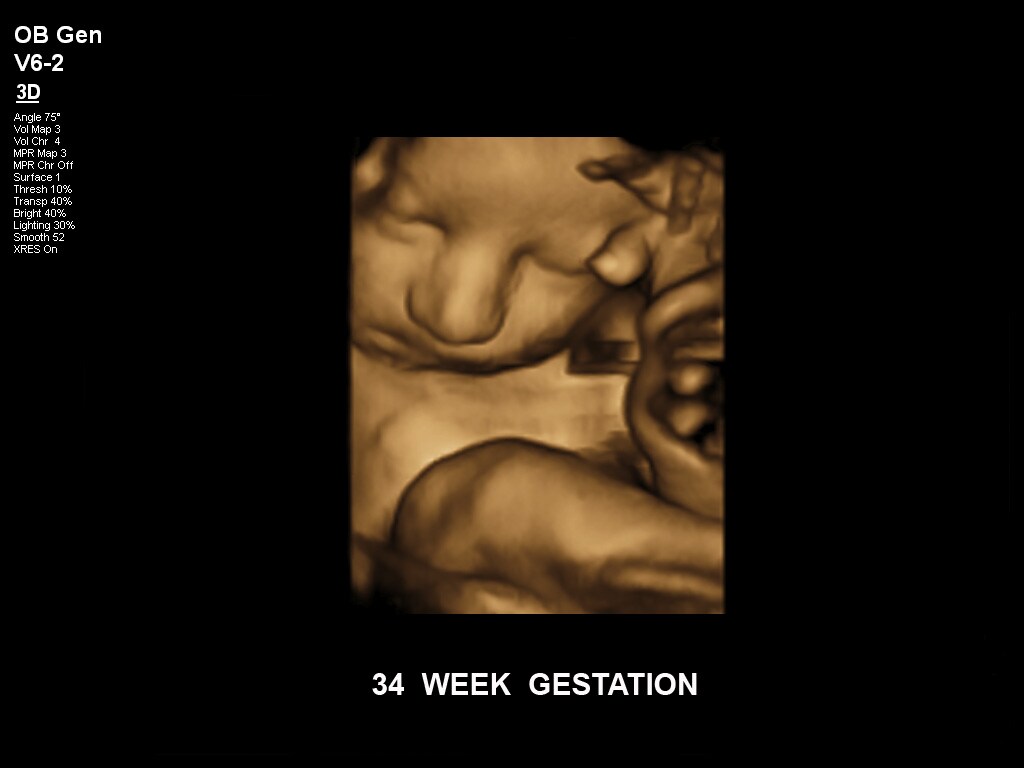 34 semaines de gestation