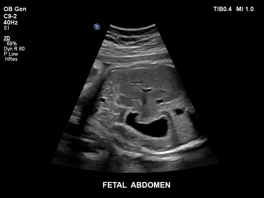 Abdomen fetal